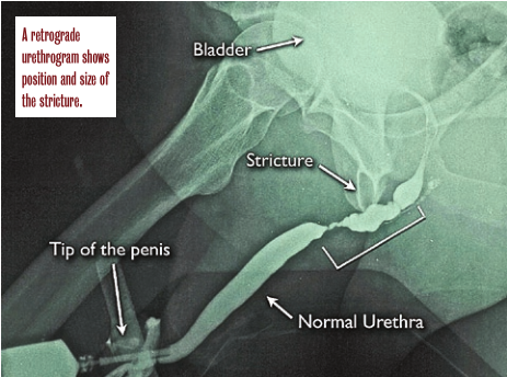 urethral